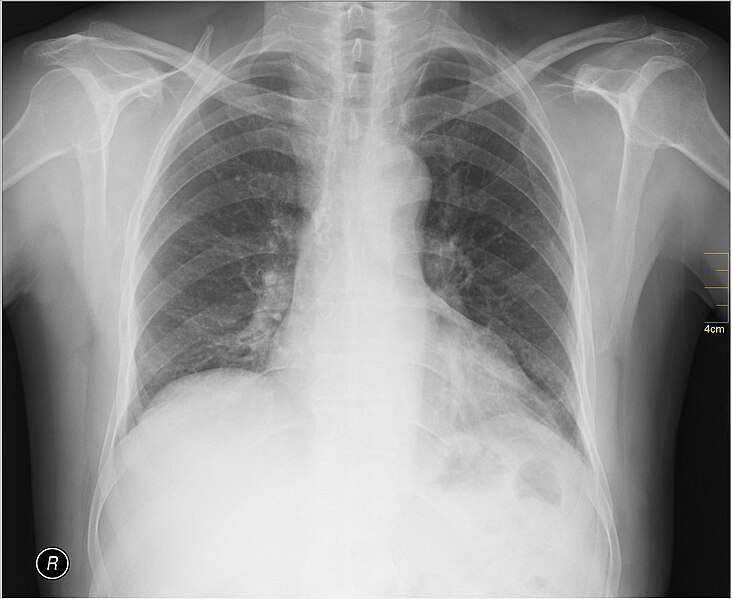 File:Medical X-Ray imaging QNN06 nevit.jpg