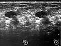 Nódulo mamografico BR0-Ecografía