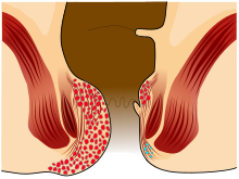 Piles Grade 4.svg