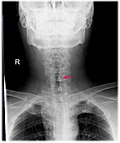 Thumbnail for Subglottic stenosis