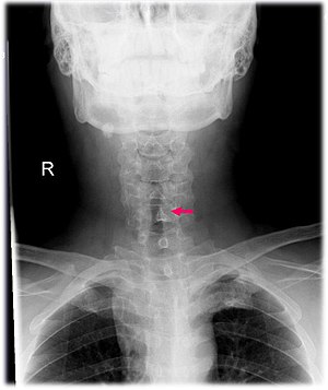 Subglottic stenosis (X-ray).jpg
