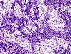 Histopathological image of metastatic seminoma in the inguinal lymph node. Hematoxylin & eosin stain.