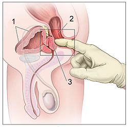 chirurgie de ladénome de la prostate)