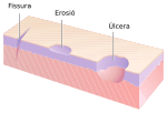 Miniatura per Clivella (dermatologia)