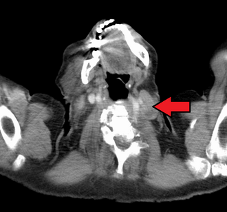 An enlarged Virchow's node as seen on CT Virchow'sNodeMark.png