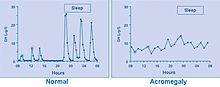 Frequent serum GH measurements in normal subjects (left panel) demonstrate that GH can fluctuate between undetectable levels most of the time interspersed with peaks of up to 30 mg/L (90 mIU/L); in acromegaly (right panel) GH hypersecretion is continuous with no undetectable levels. Acromegaly growth hormone levels.JPEG