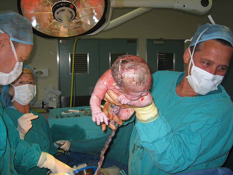 File:Caesarian shown close.jpg