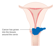 Diagram showing stage 2B cervical cancer CRUK 216.svg