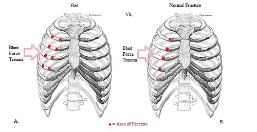 This picture demonstrates the placement of fractures in a chest that would be considered a flail chest versus a normal chest fracture in one segment of a rib.