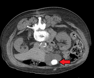Large gallstone as seen on CT