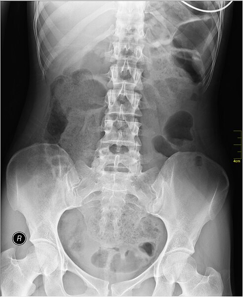 File:Medical X-Ray imaging PVX06 nevit.jpg