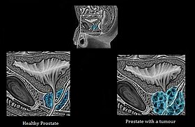 Rak prostaty.jpg