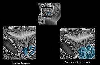 Differences between healthy prostate and a prostate with a tumour Prostate Cancer.jpg