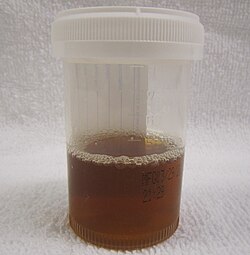 A container half-full with brown-stained urine, characteristic for rhabdomyolysis