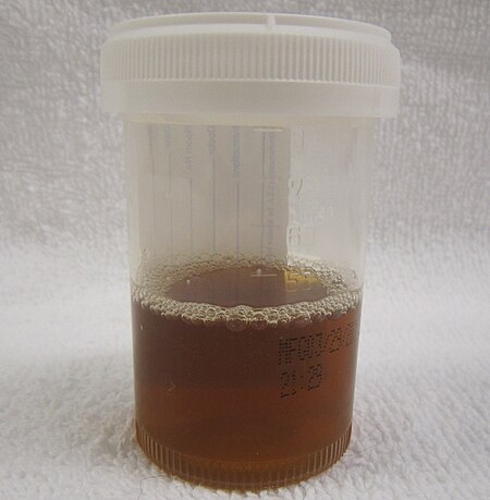 A container half-full with brown-stained urine, characteristic for rhabdomyolysis