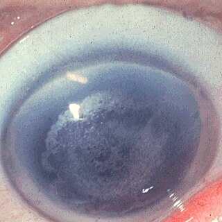 <span class="mw-page-title-main">Schnyder crystalline corneal dystrophy</span> Medical condition