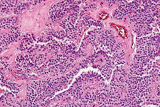 Solid pseudopapillary tumour