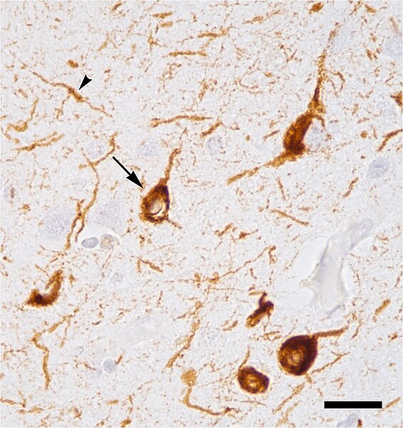 File:Tauopathy in Alzheimer's disease.jpg