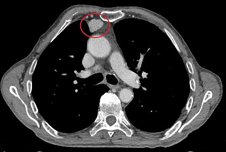 CT-scanning i mediastinalt vindue, der viser et lille thymom foran de store kar.