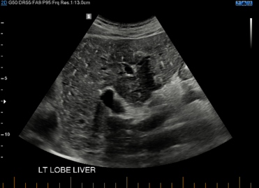 von Meyenburg Complex in ultrasound. Numerous little cysts with ringdown artefacts.