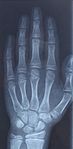 Một bức ảnh chụp X-quang bàn tay người.