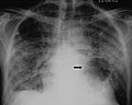 X-ray of cyst in pneumocystis pneumonia 1.jpg