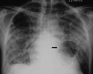 X-ray of a cyst in pneumocystis pneumonia[6]