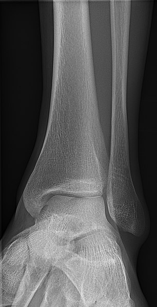 File:X-ray of normal ankle - 15 degrees internal rotation.jpg