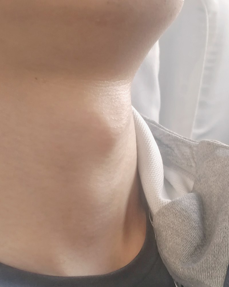 Adam s apple