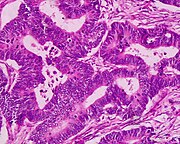 Adenocarcinoma altamente differenziato (retto) H&E magn 400x.jpg