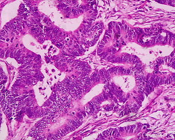 Colorectal adenocarcinoma under H&E stain.