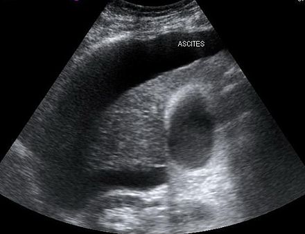 The development of ascites (as shown on this abdominal ultrasound) in cirrhotics that is refractory to the use of diuretic medications is associated with type 2 HRS.