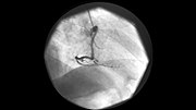 Thumbnail for File:CAG+PTCA 67Yrs Male (1019).jpg