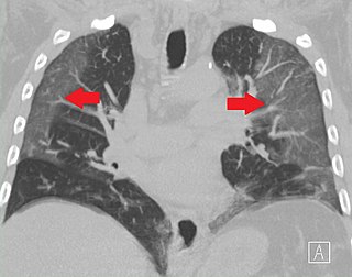 Ground-glass opacity Radiologic sign on radiographs and computed tomography scans