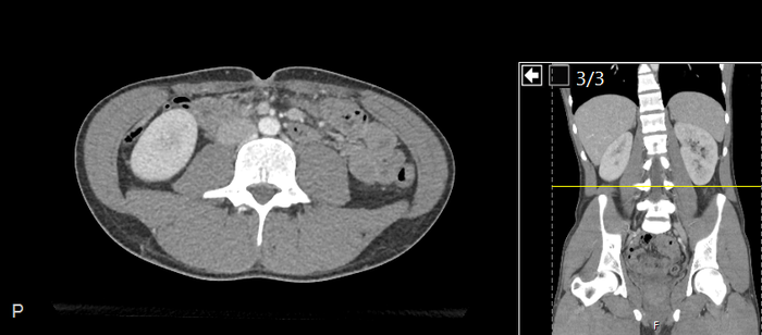 CT of a normal abdomen and pelvis, axial plane 145.png