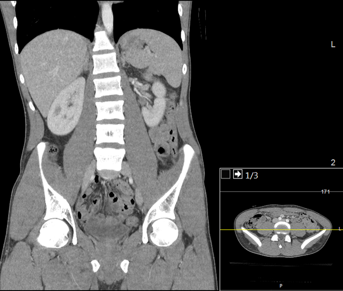 CT of a normal abdomen and pelvis, coronal plane 77.png