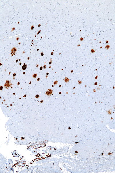 File:Cerebral amyloid angiopathy -2a- amyloid beta - low mag.jpg