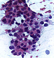 Cytopathology of infiltrating duct carcinoma breast 400x.jpg