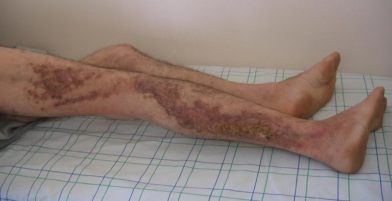 Dermatological disorders in Tuvalu between 2009 and 2012