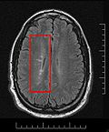 Thumbnail for Lesional demyelinations of the central nervous system