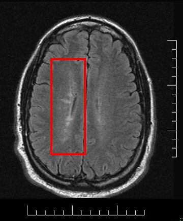 Lesional demyelinations of the central nervous system