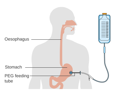 What is a percutaneous endoscopic gastrostomy?