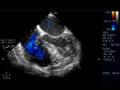 Fitxer:Doppler ultrasound of heart with endocarditis - 1476-7120-8-44-S4.MPEG.ogv