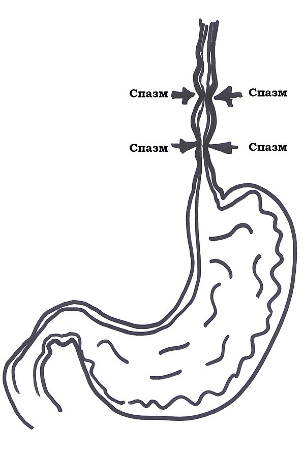 Колики в желудке причины. Диффузионный спащм пищевода. Спастические сокращения пищевода.