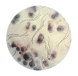 Haemophilus ducreyi גורם המחלה