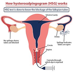 HSG test to know the blockage of the fallopian tubes Hysterosalpingogram (HSG).jpg