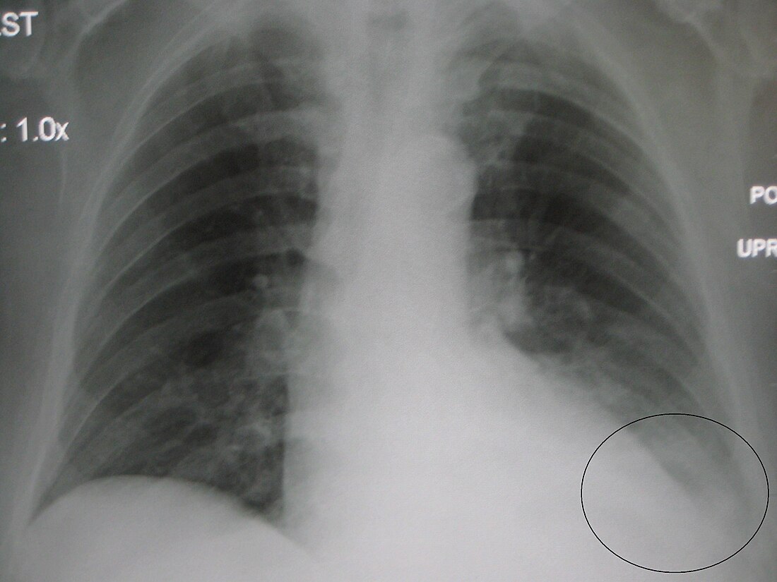 File:LLL pneumonia with effusionM.jpg