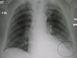 Parapneumonic effusion Medical condition