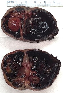 thyroid carcinoma