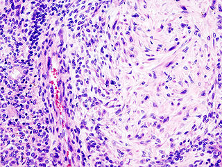 Pleomorphic adenoma Medical condition